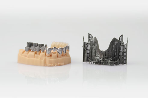 Dental prostheses (steps in production from left to right: with support structures,surface ready for veneer, after ceramic veneer) on a dental model and removable partial denture (right)