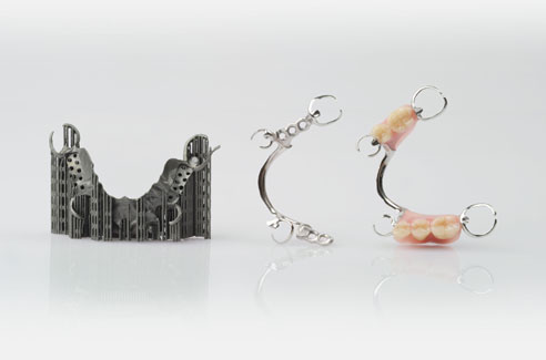 Stages of production for an additive manufactured removable partial denture: Dental prosthesis directly after manufacturing, with support structures removed and surface polished, after completion (lef