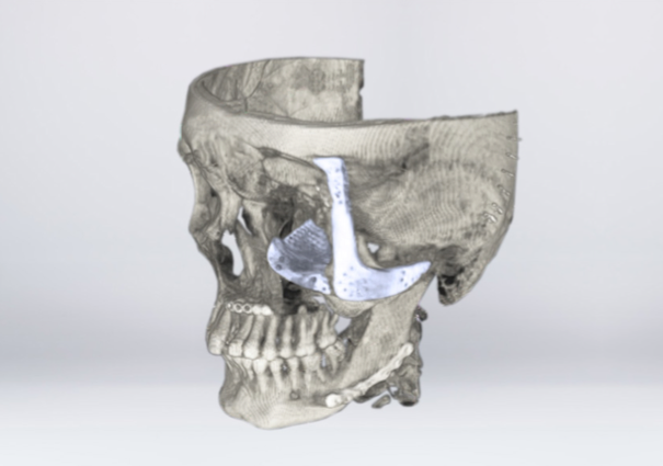 手术后颧骨和眶骨植入物的 CT 图像(来源:CSIR-CSIO)